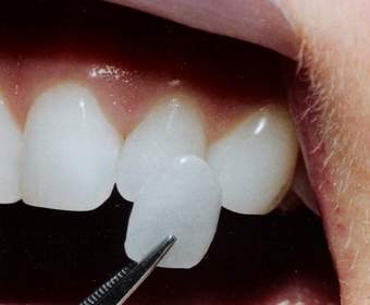 Использование виниров на зубы